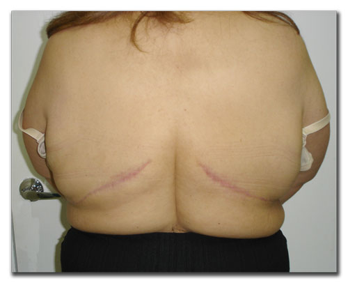 panniculectomy after panniculectomy after